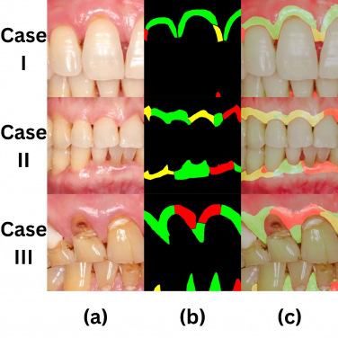 三個個案顯示牙醫目測 (b) 和利用人工智能檢測 (c) 牙齦狀況
(a) 口腔照片
(b) 由牙醫標記的健康情況: 綠色=健康，紅色=患病，黃色=疑有患病
(c) AI檢測結果
(照片來源：港大牙醫學院）
 